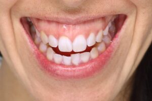 Close-up of a woman’s smile showing prominent gums, highlighting cosmetic dental enhancements like veneers
