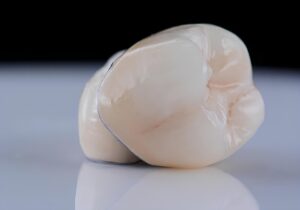 Glass ceramic dental veneers and porcelain crowns used in smile design treatment, showcasing laminate veneers, porcelain bridges, and dental restorations for aesthetic enhancement