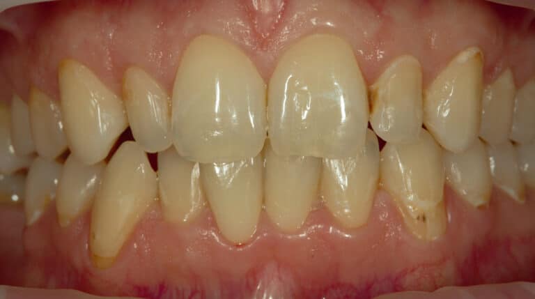 Before Image: Veneers - front