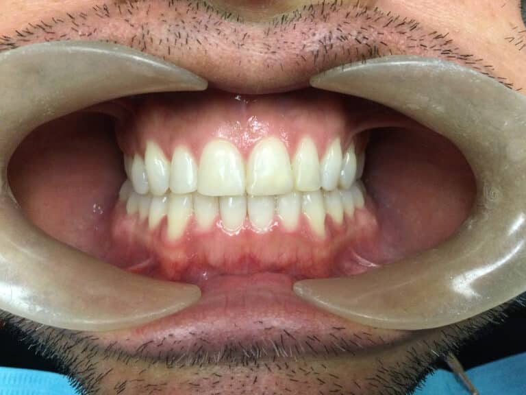 After Image: No Cutting Bonding - front