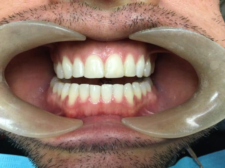 After Image: No Cutting Bonding - front