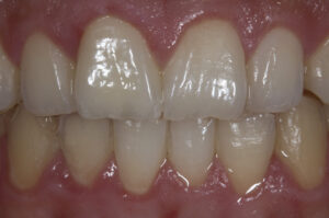 After Image: Veneers