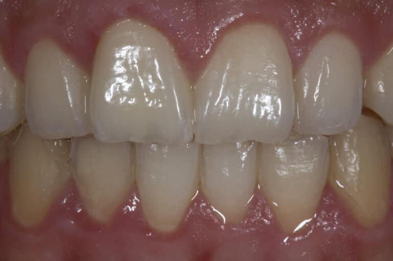 After Image: Veneers - front